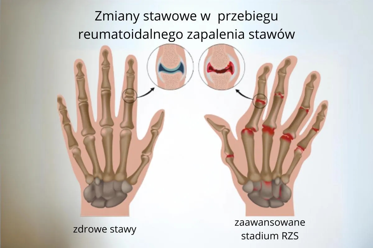 Reumatoidalne zapalenie stawów u dzieci objawy, które mogą zaskoczyć rodziców