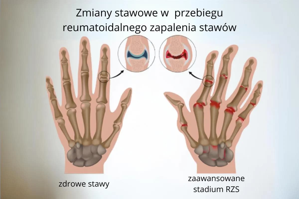 Reumatoidalne zapalenie stawów u dzieci objawy, które mogą zaskoczyć rodziców