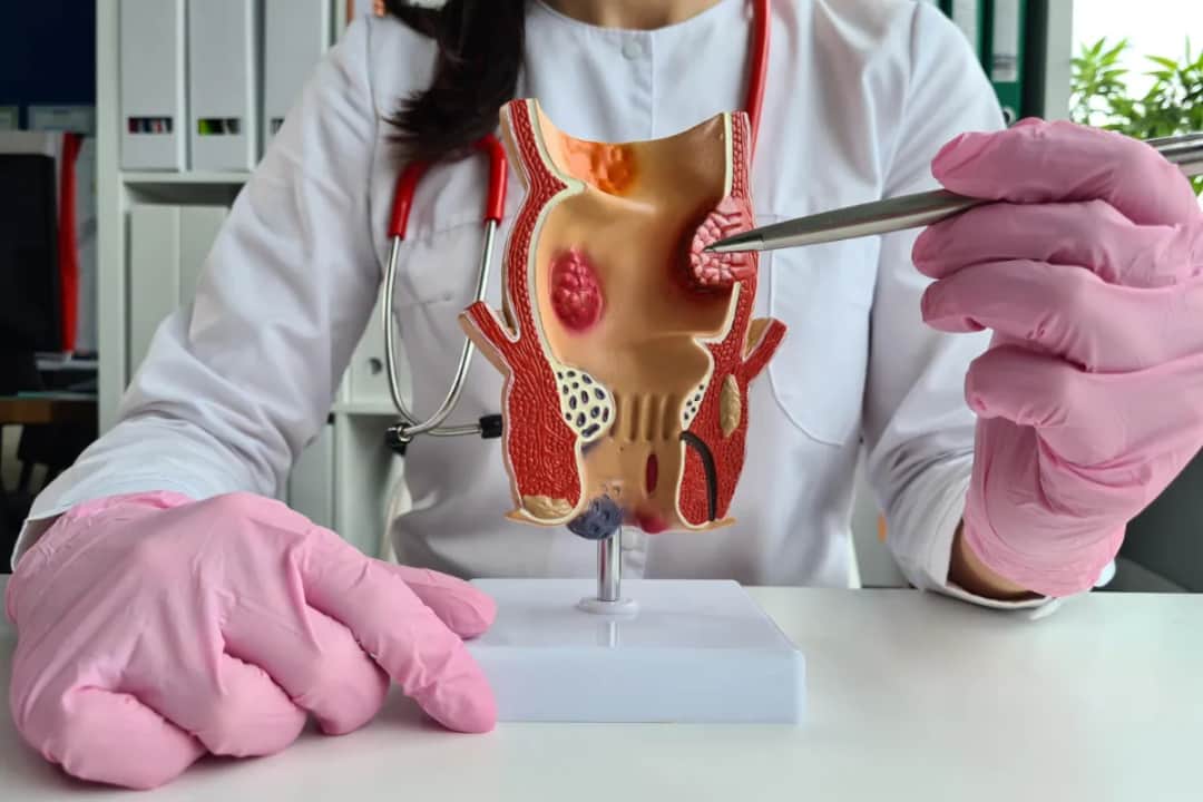 Hemoroidy do jakiego lekarza? Dowiedz się, jak uzyskać pomoc