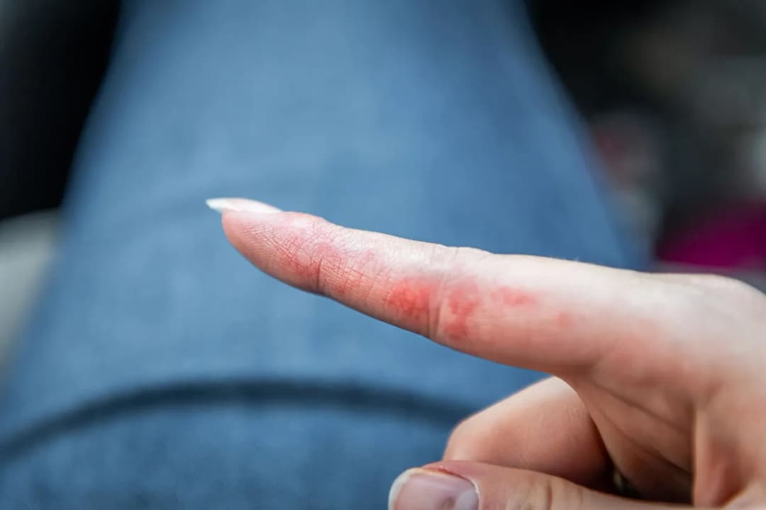Czy NeoNail uczula? Objawy alergii i jak ich unikać