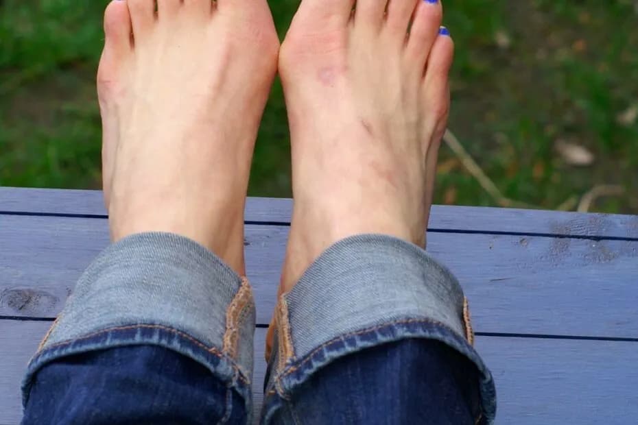 Jak złagodzić ból haluksa? Skuteczne metody i porady