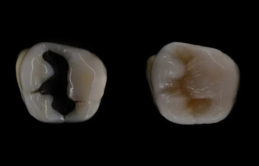 Ile kosztuje plomba światłoutwardzalna na nfz? Sprawdź, co musisz wiedzieć