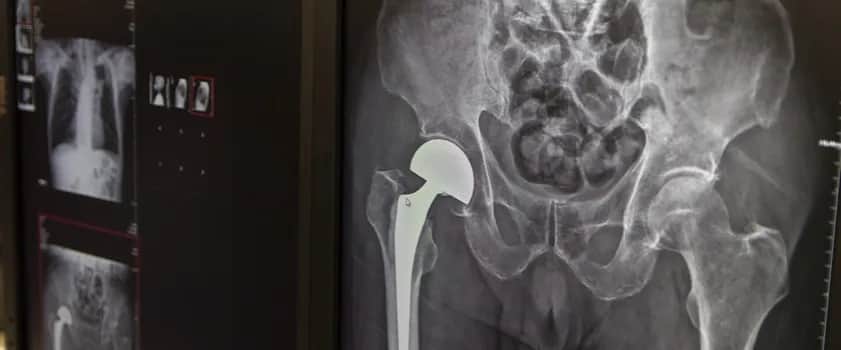 Obluzowanie endoprotezy stawu biodrowego – objawy, które mogą niepokoić