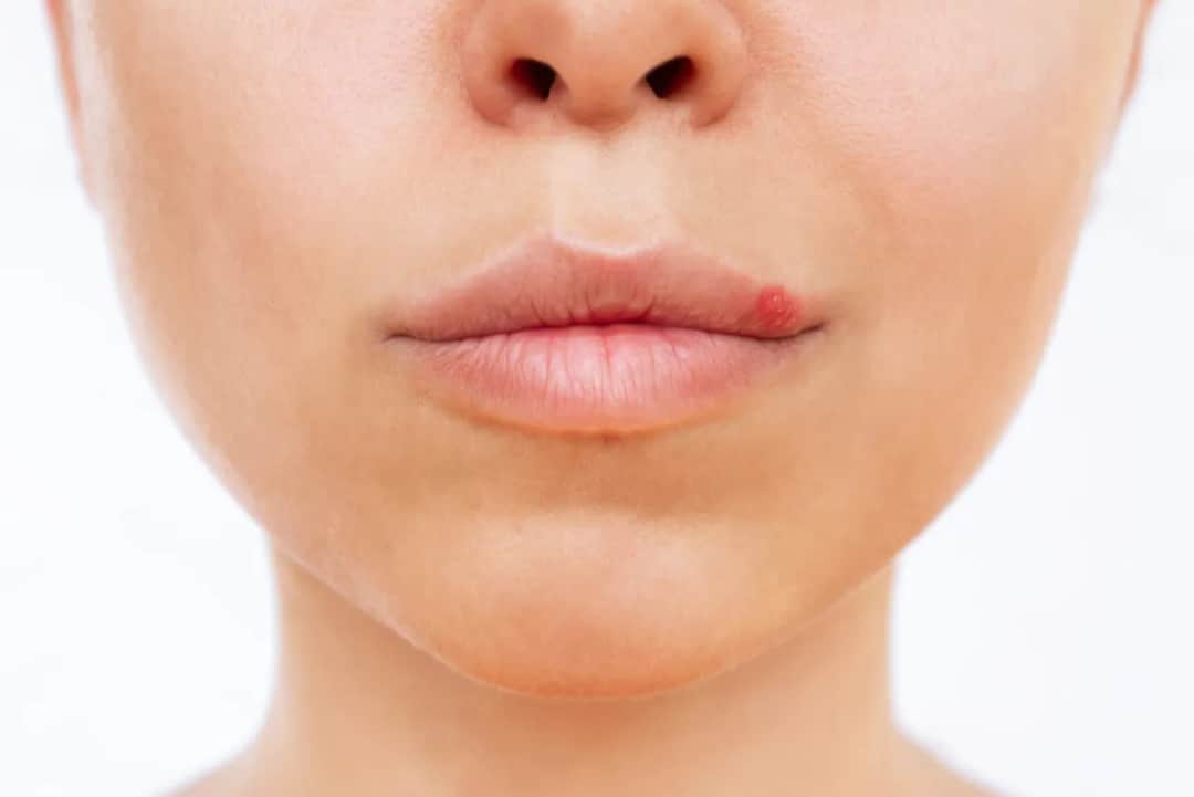 Jak zapobiec opryszczce - skuteczne metody unikania nawrotów