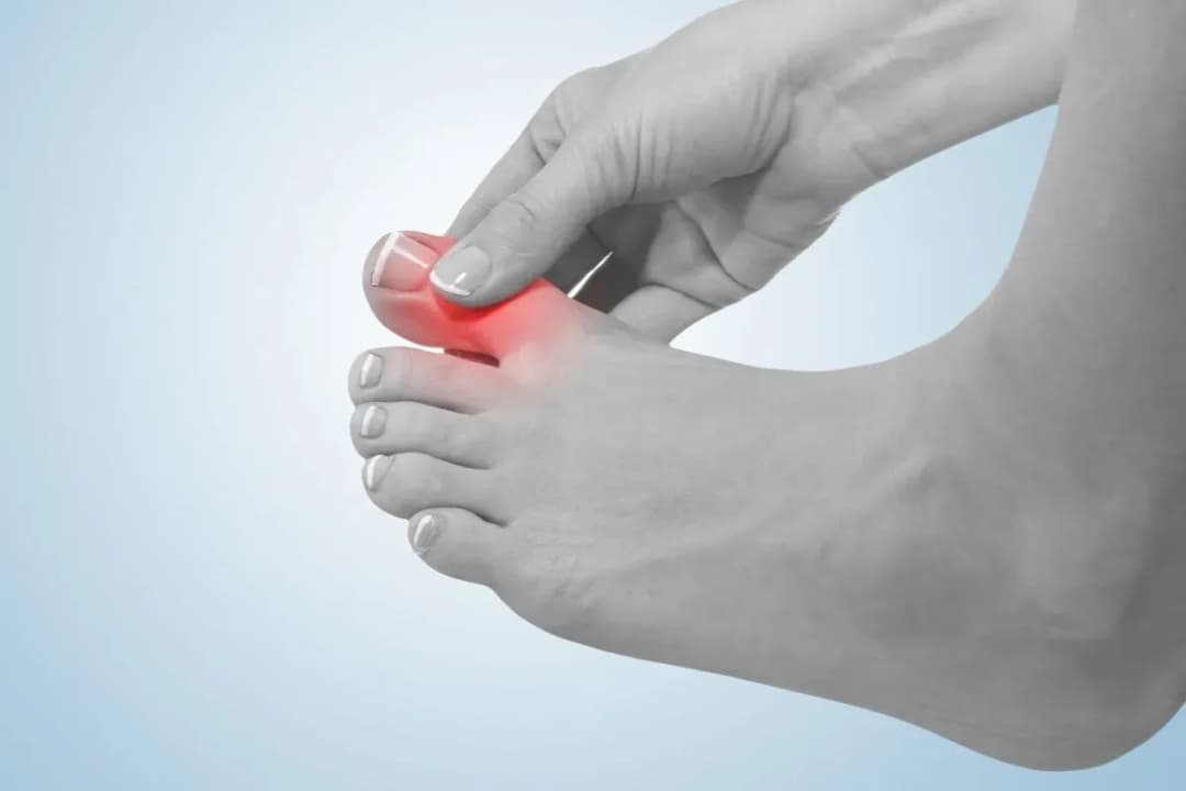 Jakie badania na dna moczanową pomogą uniknąć bólu stawów?