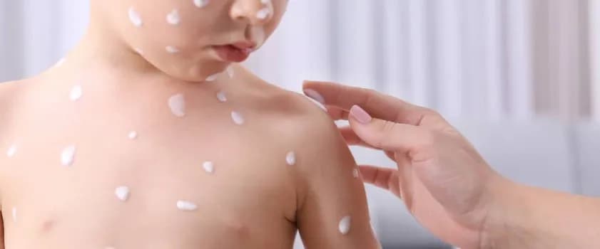 Jak zapobiec ospie po kontakcie z chorym i uniknąć zakażenia