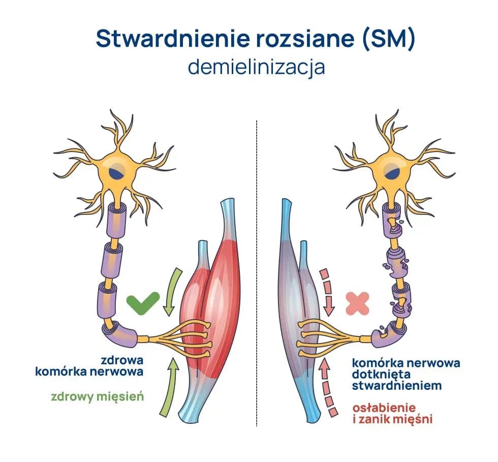 Stwardnienie rozsiane: pierwsze objawy, które mogą Cię zaskoczyć