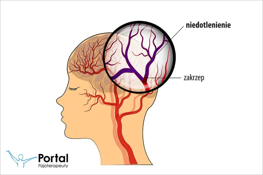 Objawy niedotlenienia mózgu: jak je rozpoznać i co robić?