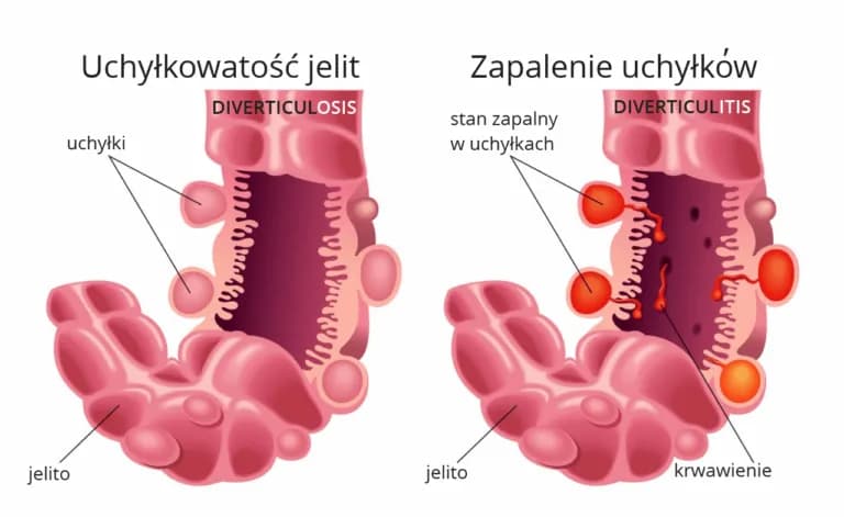 Zapalenie uchyłka jelita objawy - rozpoznaj ból i inne symptomy