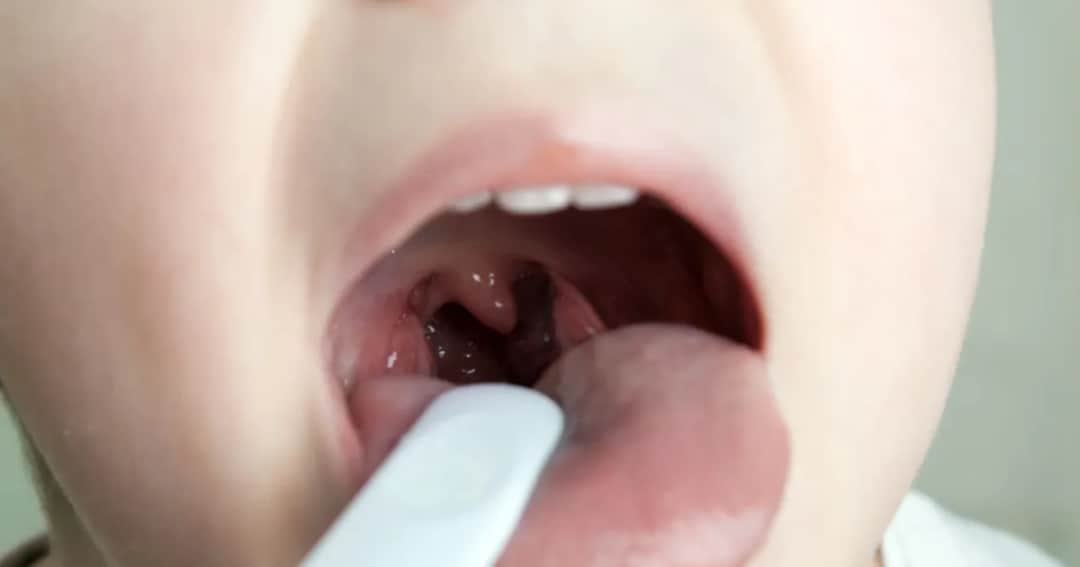 Skuteczne sposoby na ból gardła dla 2 latka, które działają