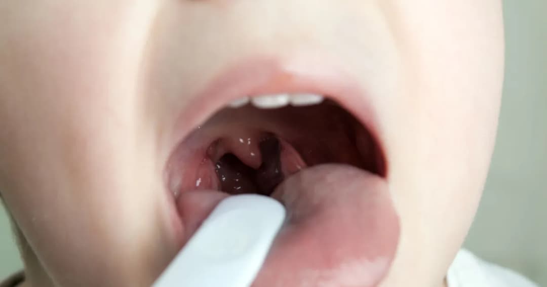 Skuteczne sposoby na ból gardła dla 2 latka, które działają