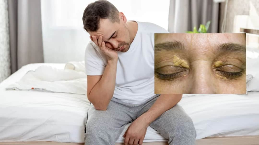 Podwyższony cholesterol objawy: jak je rozpoznać i co robić?