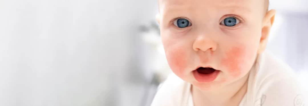 Czy banan uczula niemowlaka? Objawy i bezpieczeństwo dla dzieci