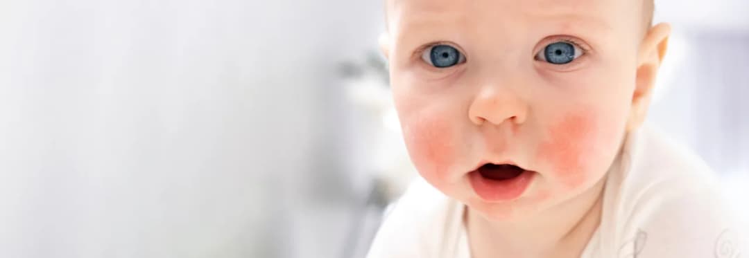 Czy banan uczula niemowlaka? Objawy i bezpieczeństwo dla dzieci