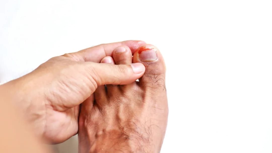 Zanokcica jaki lekarz? Dowiedz się, kto pomoże w leczeniu tej dolegliwości