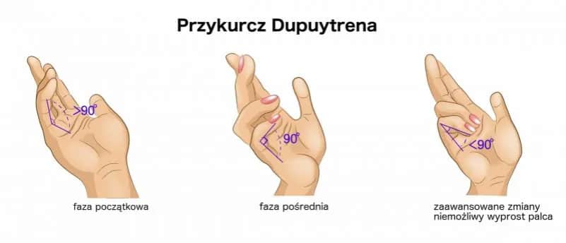 Przykurcz dupuytrena do jakiego lekarza? Sprawdź, kogo wybrać