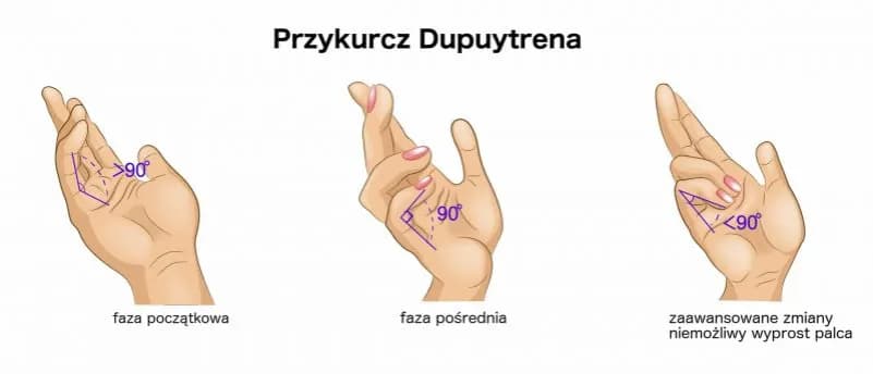 Przykurcz dupuytrena do jakiego lekarza? Sprawdź, kogo wybrać