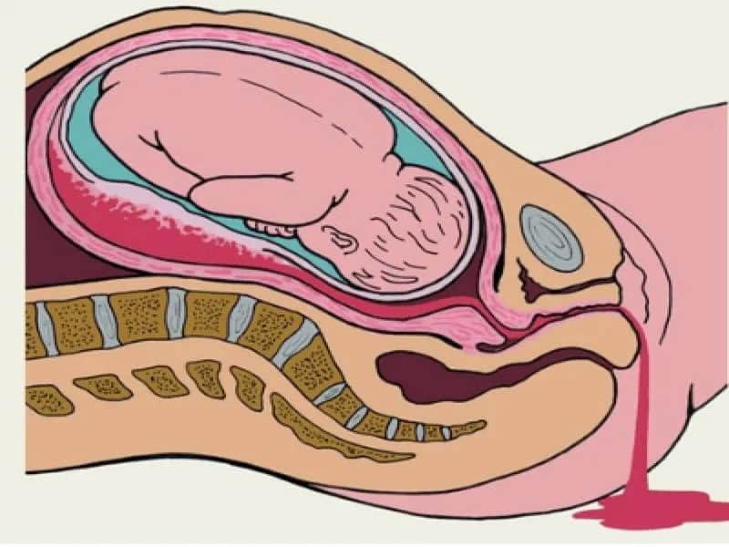 Pęknięcie krwiaka w ciąży objawy – co musisz wiedzieć, by nie przegapić