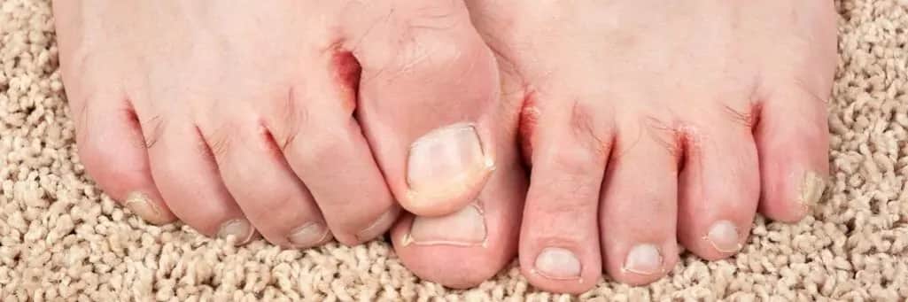 Pierwsze objawy grzybicy na stopach – jak je rozpoznać i uniknąć problemów