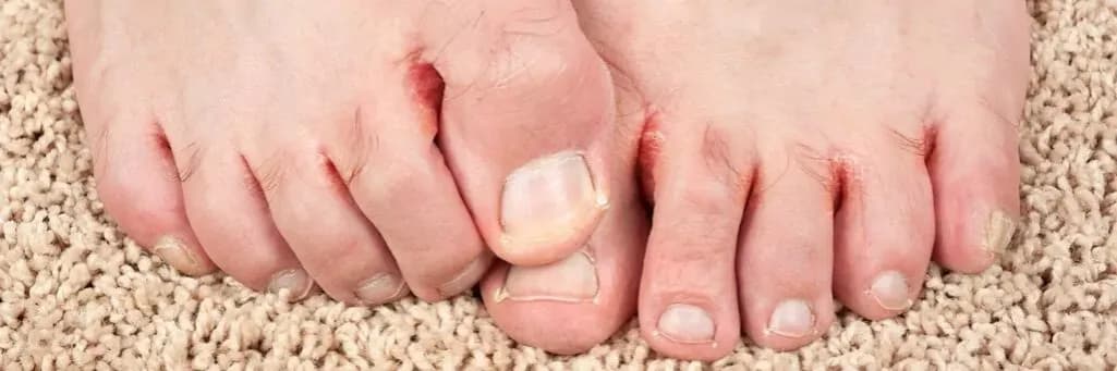 Pierwsze objawy grzybicy na stopach – jak je rozpoznać i uniknąć problemów