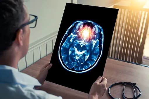 Jak zapobiec udarowi: 10 skutecznych sposobów na ochronę zdrowia